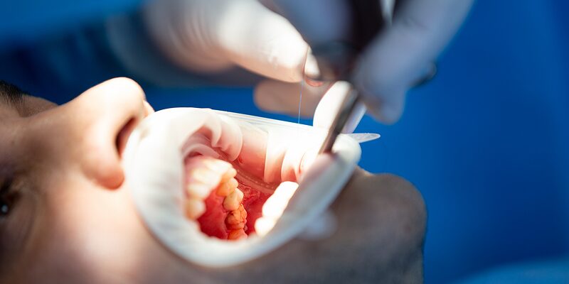 Sealants